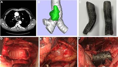 Trachea repair using an autologous pericardial patch combined with a 3D carbon fiber stent: A case report